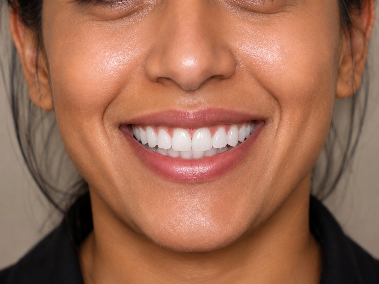 Veneers — after treatment